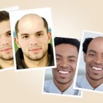 Careca! Veja como ficaria e se surpreenda com o resultado